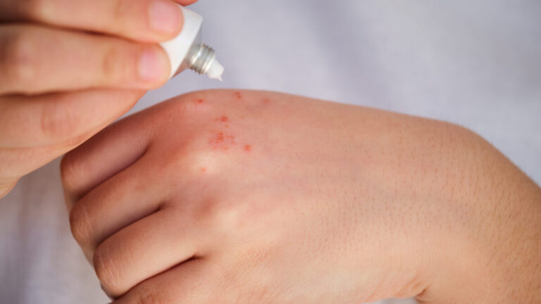 New Report Highlights the Need for Safer Corticosteroid Use